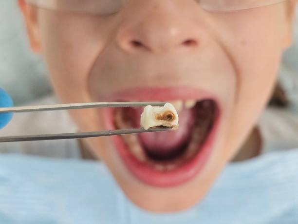 Best Broken or Cracked Tooth Emergency Dentist in Pulaski, NY